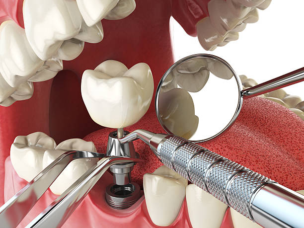 Best Emergency Root Canal Treatment in Lamar, SC
